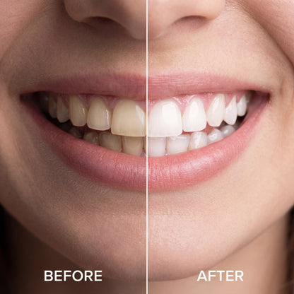 Crystal Smile Whitening Stripes